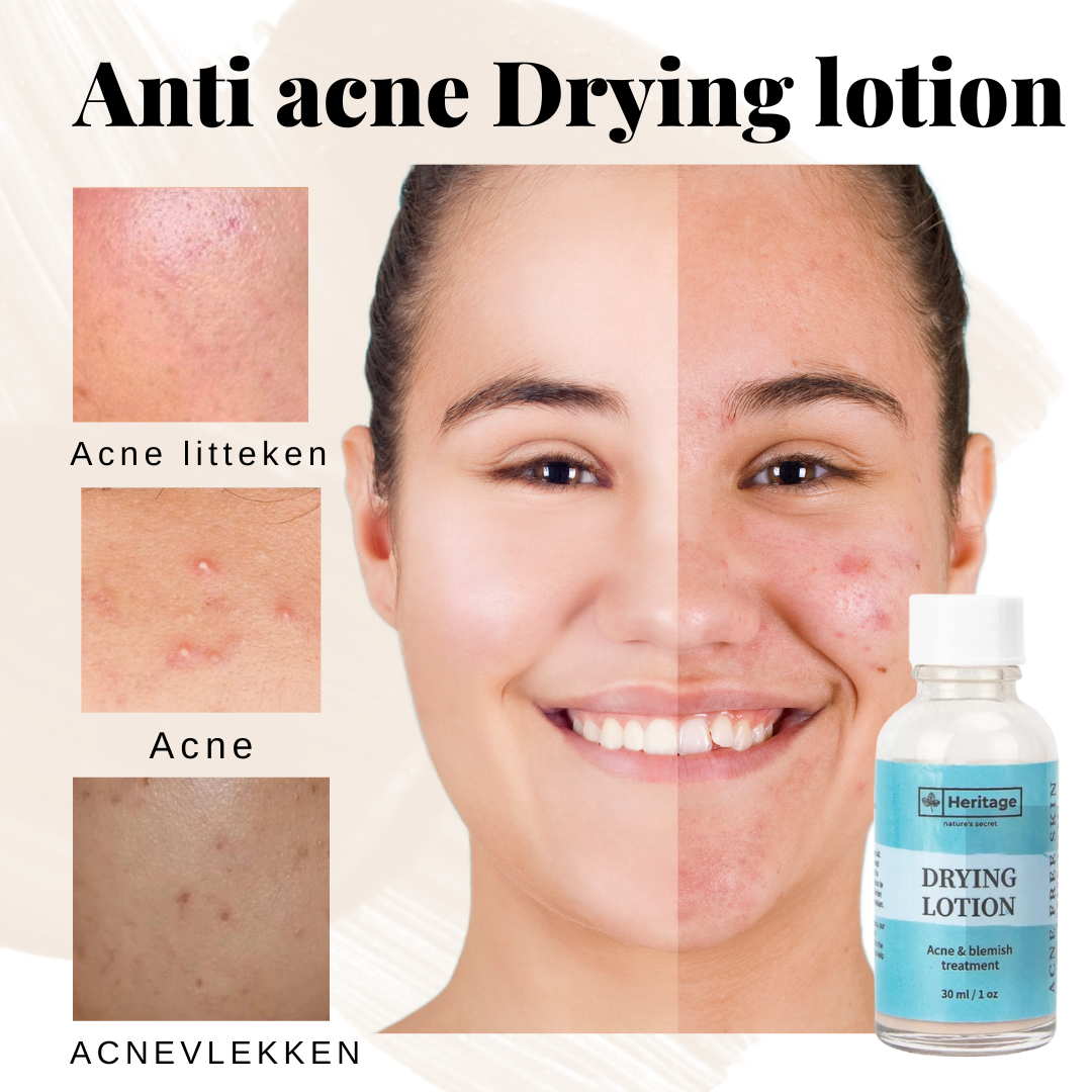 HERITAGE Anti-Acne drying lotion – De Ultieme Oplossing Tegen Puistjes, acnevlekken & Littekens | Verminder Ontstekingen & Versnel Herstel!